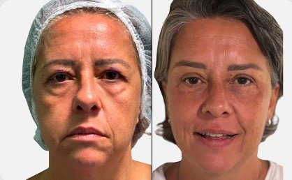 Blefaroplastia