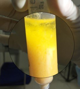 Gordura micronizada processada, rica em células regenerativas, pronta para aplicação