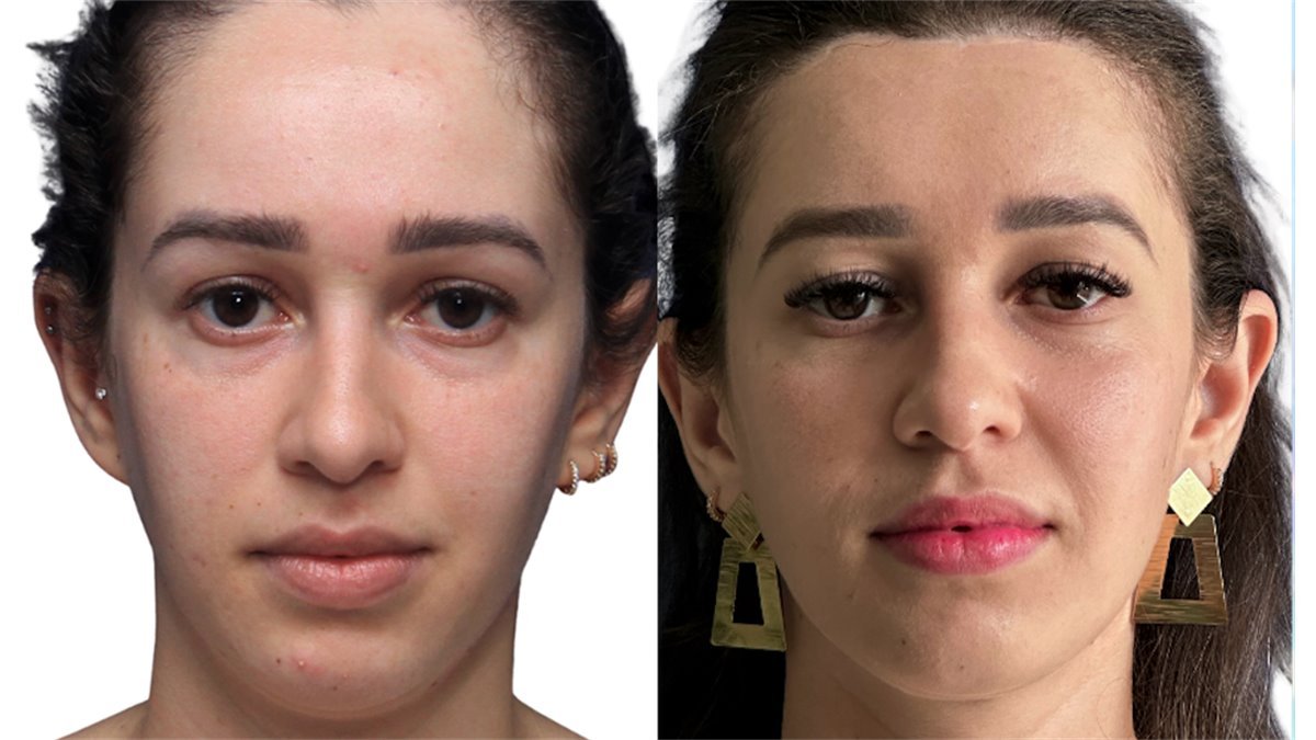 Antes e depois de cirurgia facial — paciente do Dr. Leonardo Gomes