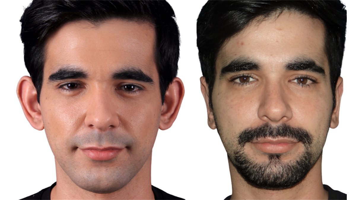 Antes e depois de cirurgia facial — paciente do Dr. Leonardo Gomes