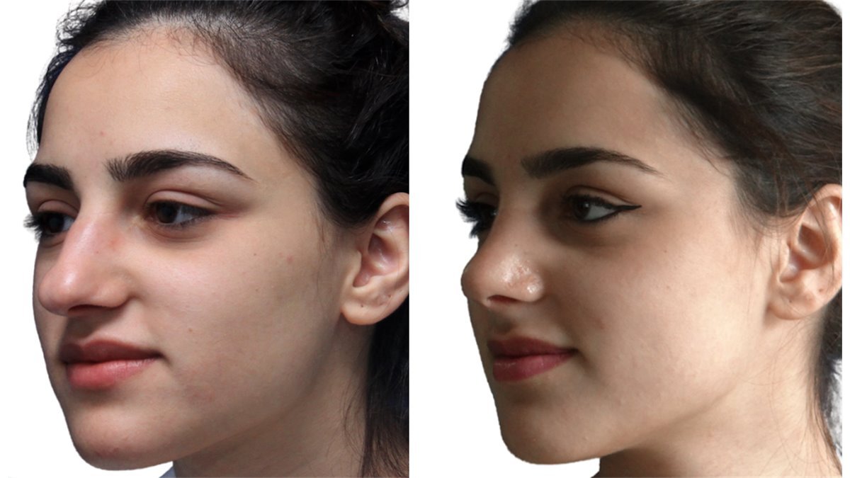 Antes e depois de cirurgia facial — paciente do Dr. Leonardo Gomes