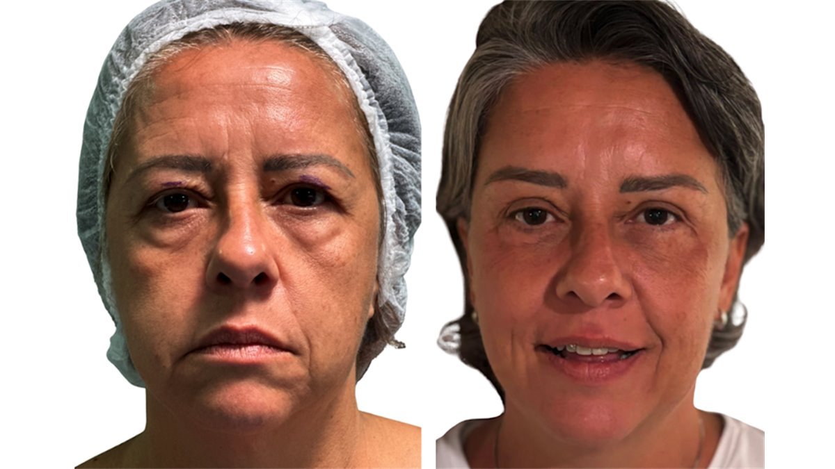 Antes e depois de cirurgia facial — paciente do Dr. Leonardo Gomes