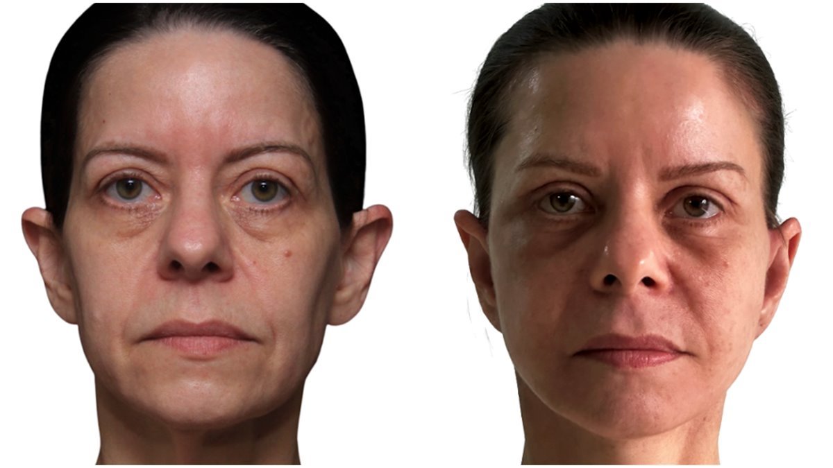 Antes e depois de cirurgia facial — paciente do Dr. Leonardo Gomes