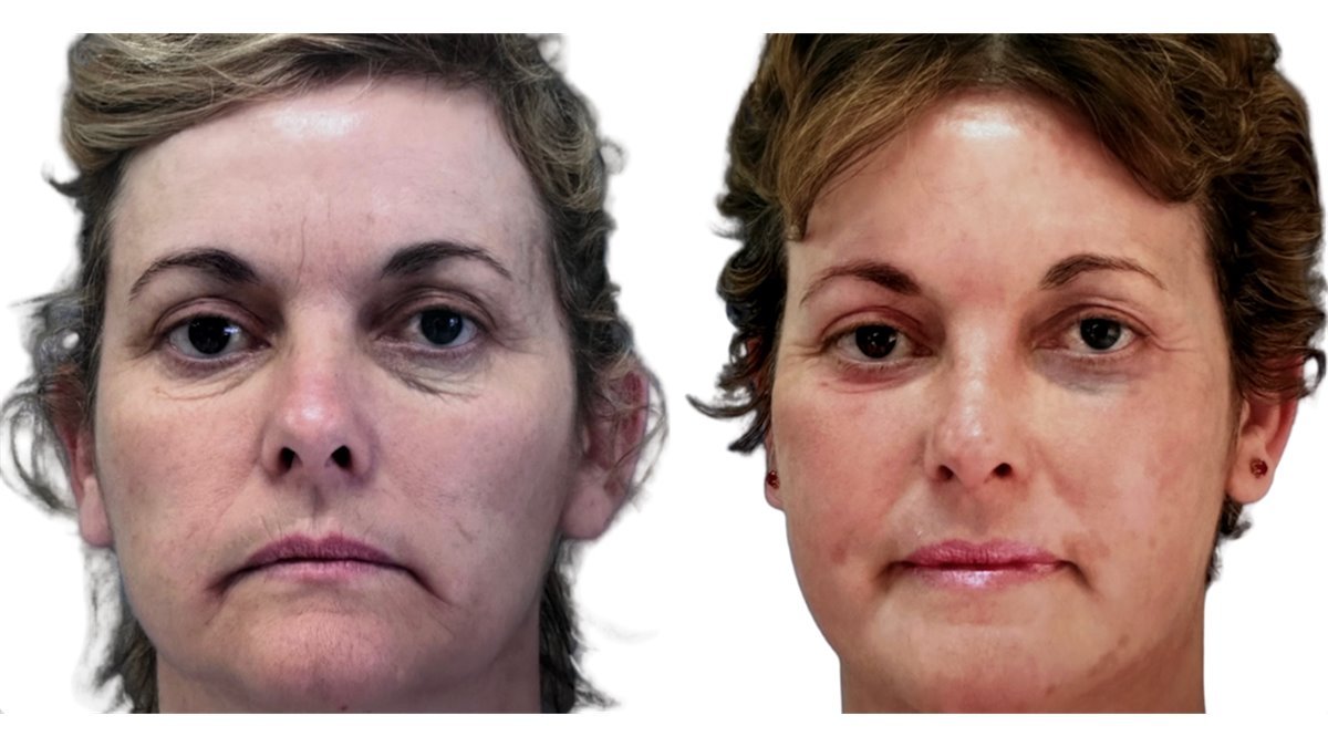 Antes e depois de cirurgia facial — paciente do Dr. Leonardo Gomes