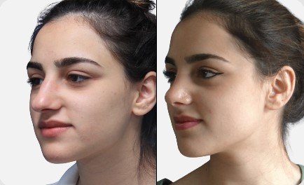 Rinoplastia